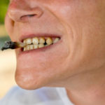 Mouth with teeth affected by nicotine